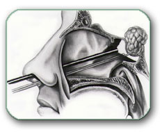 Operacija tumora hipofize kroz nos